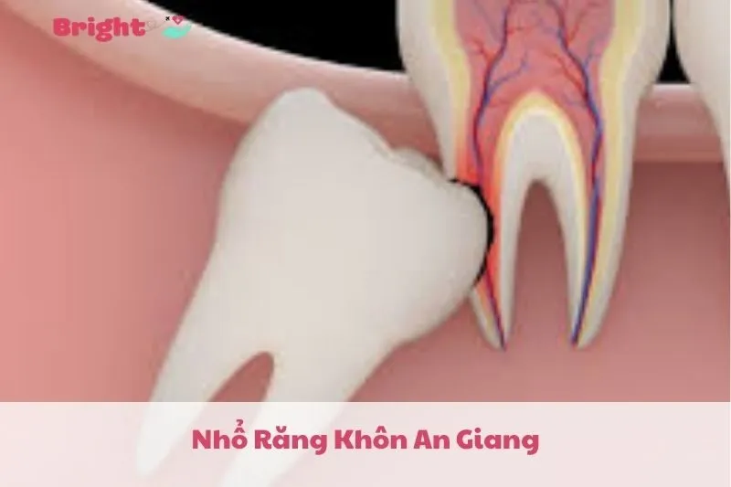 Nhổ Răng Khôn An Giang 2025: Top 5 Nha Khoa Uy Tín Tại Long Xuyên